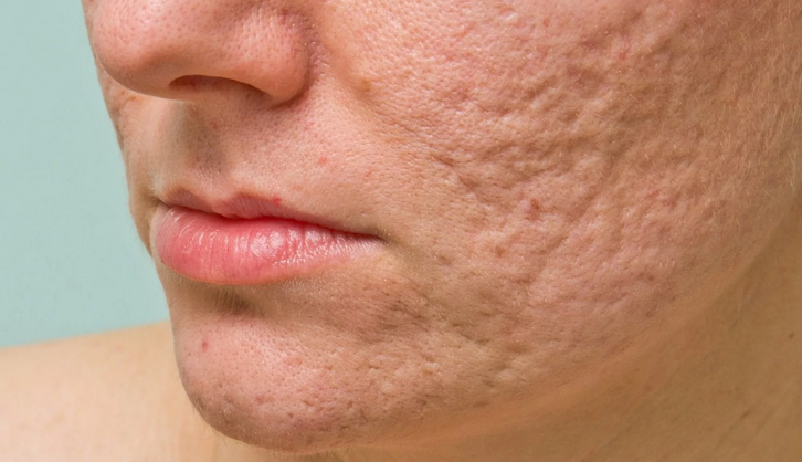 Pimples after acne on the face