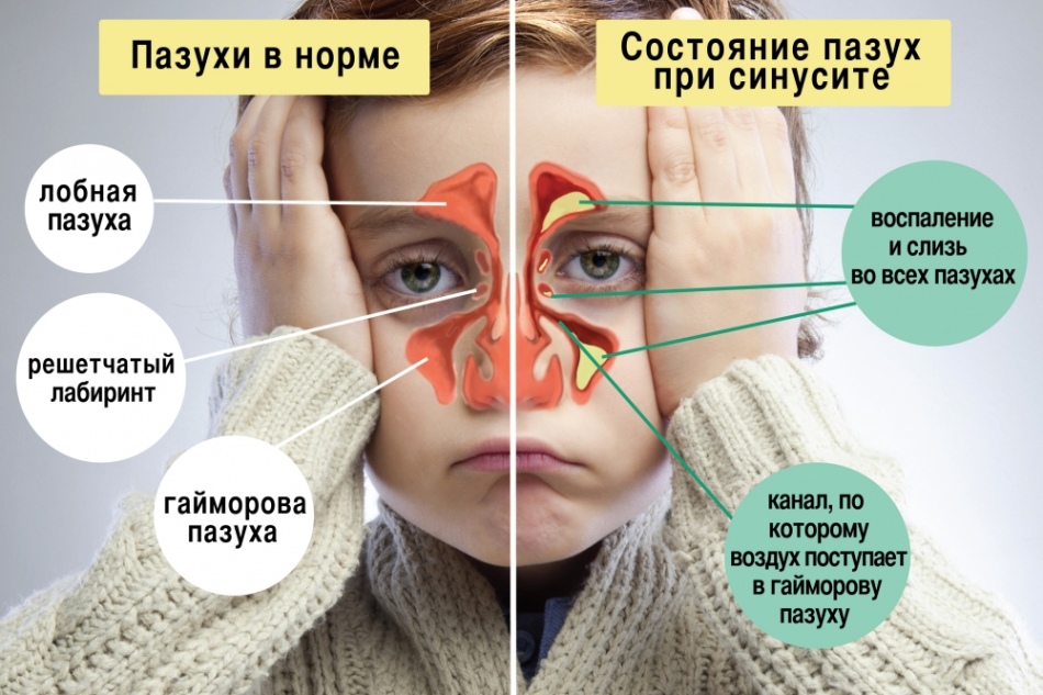 Sinus állapot sinusitis esetén