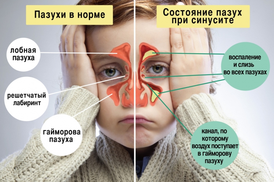 Condición sinusal para la sinusitis