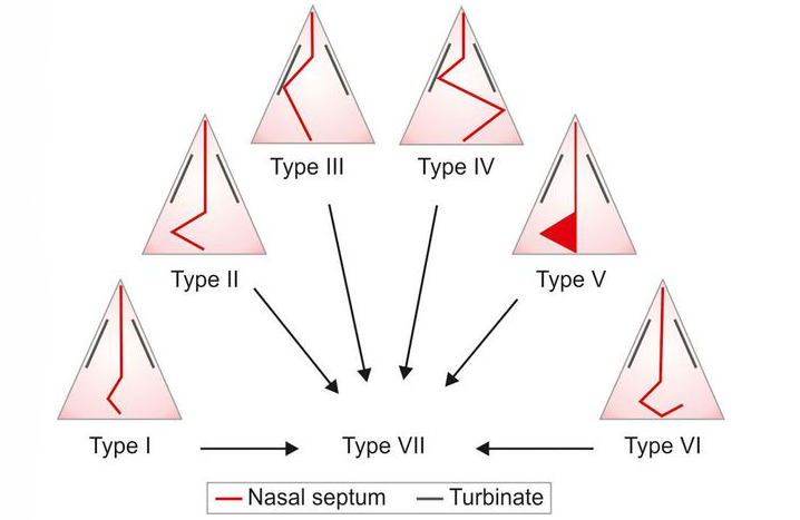 Degree of curvature of the nose septum