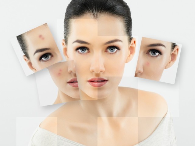 Reminoids for acne - drugs for the skin and inside: list, names, reviews. Rules for taking retinoids for acne treatment, with psoriasis