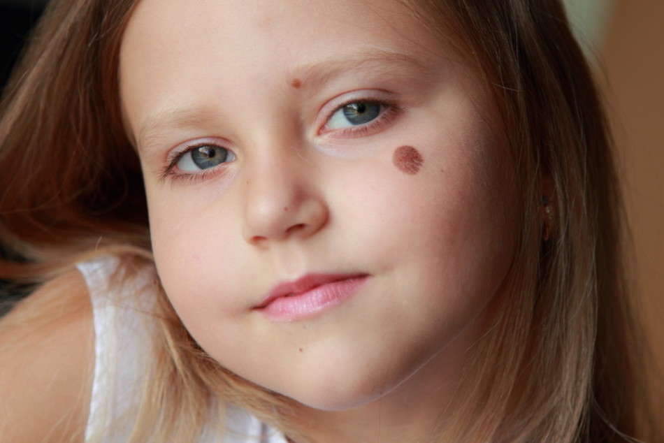 Moles in children appear after six months