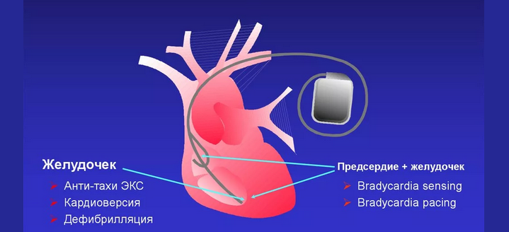 Medical automatic implantable cardiover defibrillator (ICD)