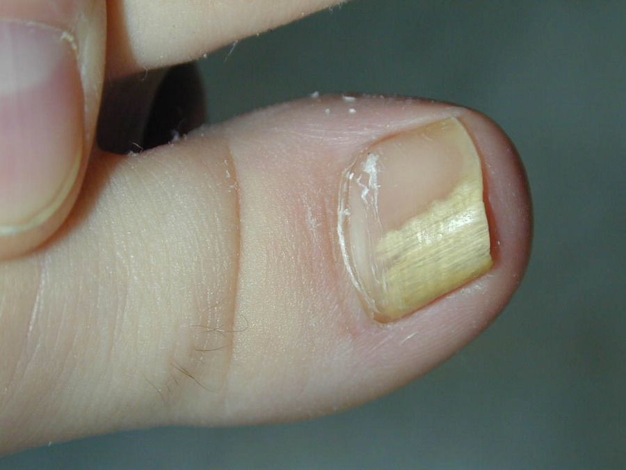 Лечение грибка ногтей по неумывакину