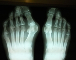 Miért jelennek meg a kúpok és a csontok az ujjakon, ízületeken? Hogyan kell kezelni a hüvelykujját műtét nélkül: A lábak dudorjainak gyógyszerei