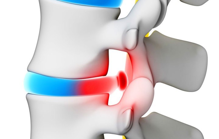 Bagian belakang sakit setelah tidur di tulang belakang karena hernia intervertebralis