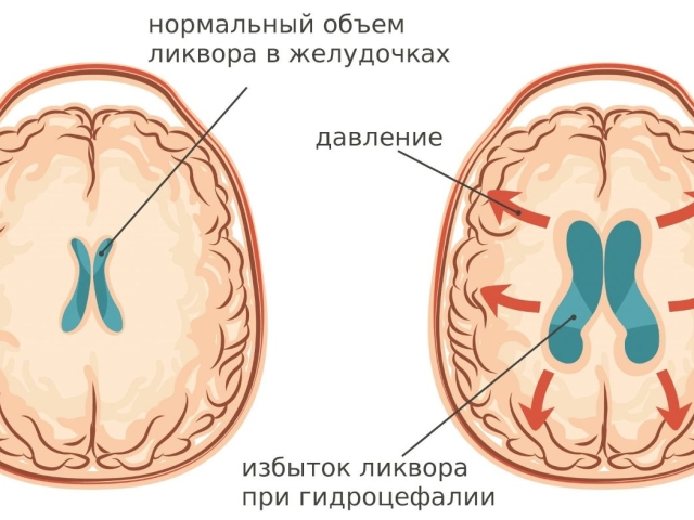 Как снизить внутричерепное давление — что это такое, как лечить: таблетки, народные средства, продукты