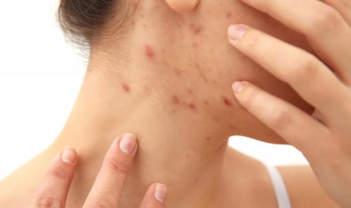 Acne on the neck