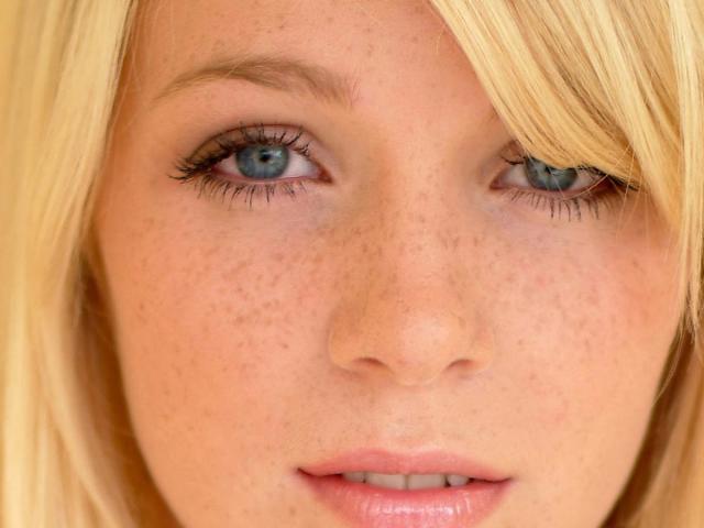 How to get rid of freckles once and for all? Removing freckles in the clinic