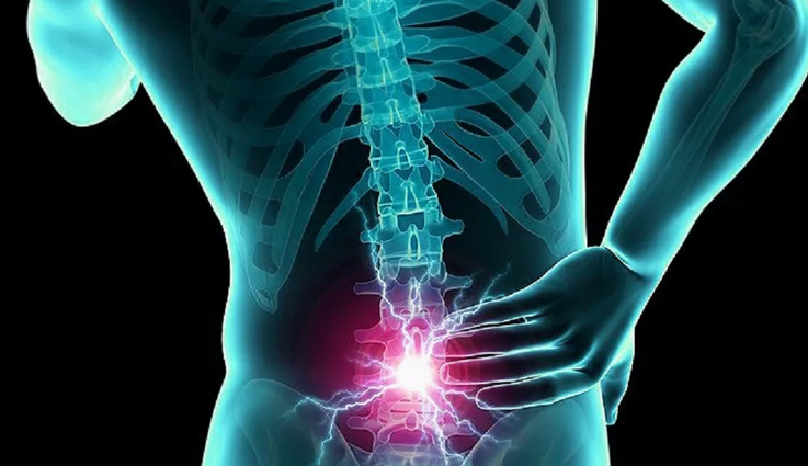 Inflammation of the lumbar hernia, pinches of the nerve of the sacral spine