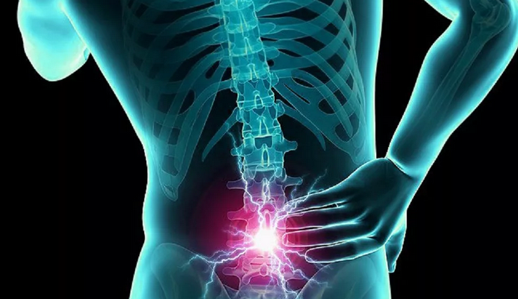 Inflamación de la hernia lumbar, pellizcos del nervio de la columna sacra