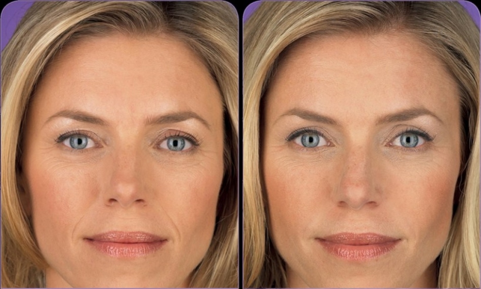 Mesotherapy - before and after