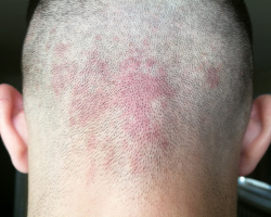 Red spots on the back of the head: reasons, what they say about what to do?
