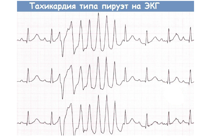 Polimorfna želodčna tahikardija na EKG
