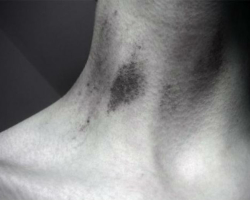 How to quickly get rid of a suction on the neck, how to remove, hide? The girl’s suction on the neck of the girl, the guy: what does it mean?