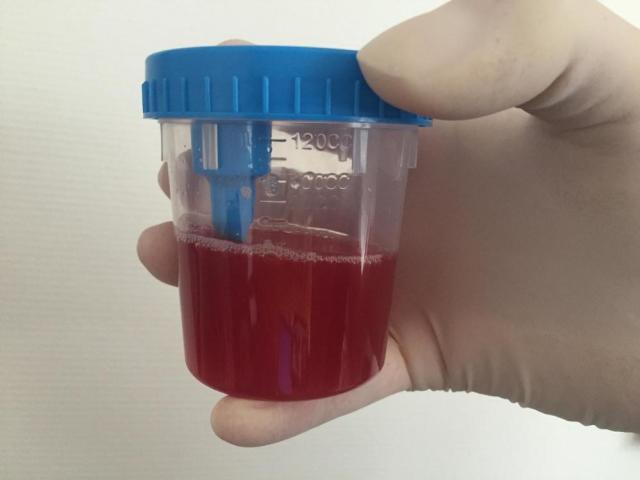 Why urine has a reddish tint: for what diseases, non -hazardous, pathological causes, additional symptoms, treatment