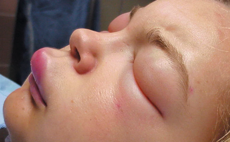 Facial edema with cones