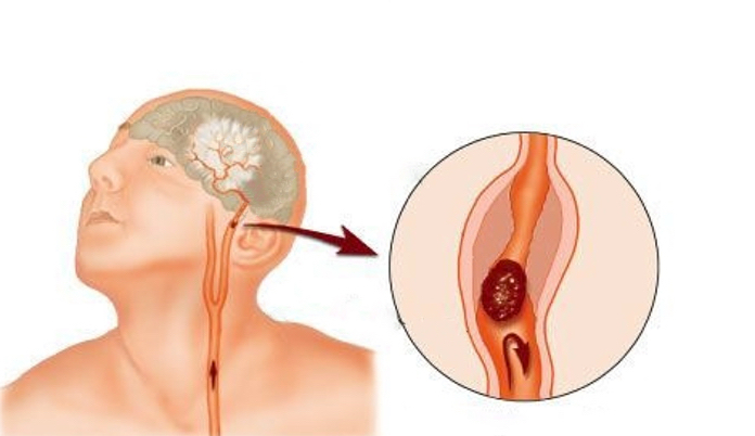 A suction on the neck can cause thrombosis and stroke.