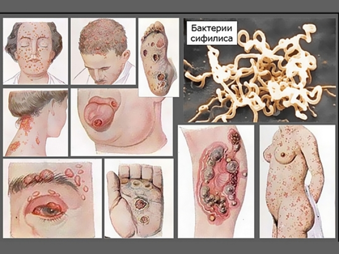 Stages of syphilis