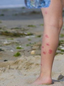 Psoriatic rashes