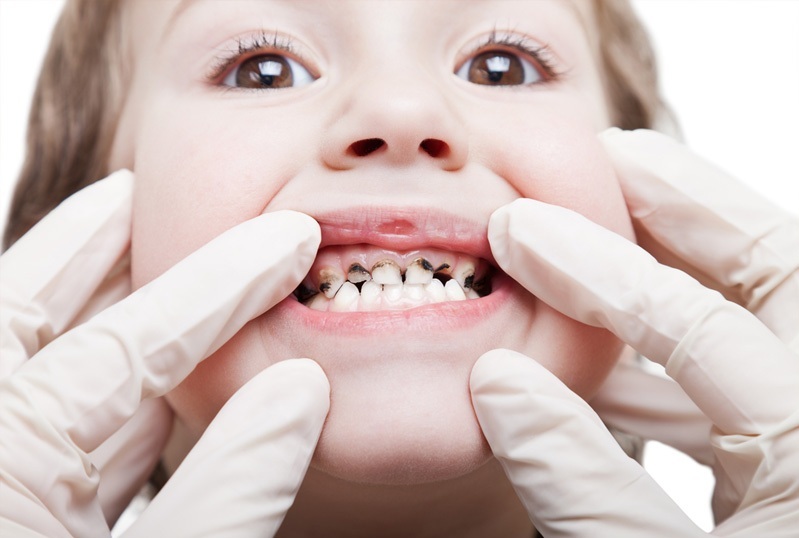 Dark plaque on children's teeth