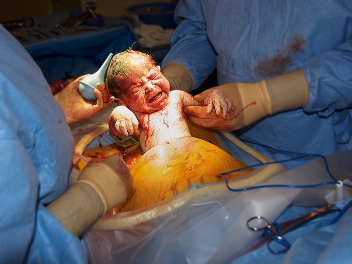 Delivery by cesarean section