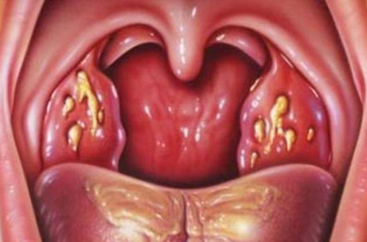 Acute tonsillitis