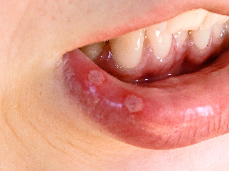 Herpetic stomatitis