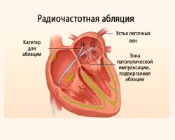 Cauterization of the heart with atrial fibrillation and tachycardia: the cost of surgery, consequences, reviews - how do they do?