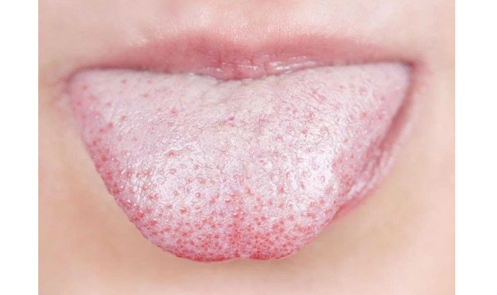 White plaque on the tongue in adults