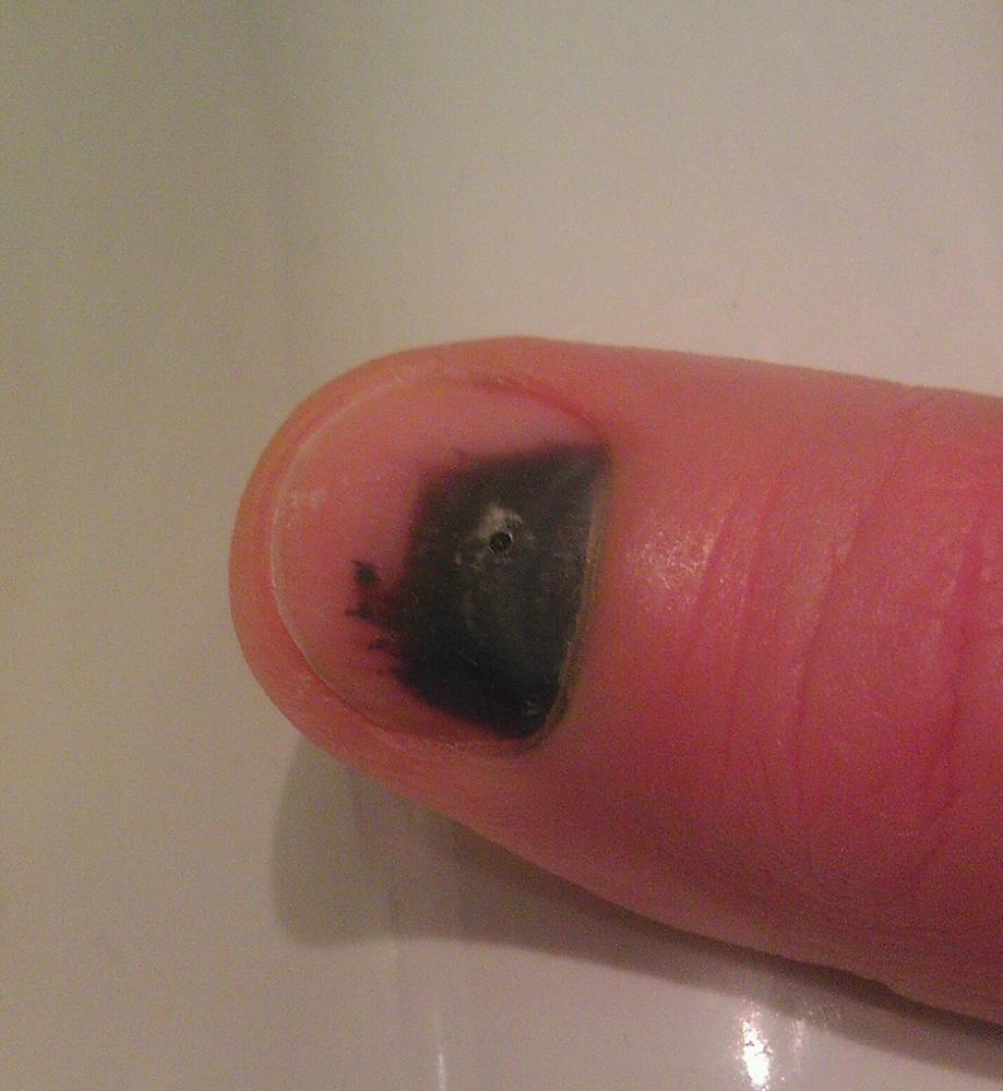 Bruise on the finger