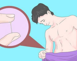 Gonore: Jenis, gejala pada pria. Bagaimana Anda bisa terinfeksi gonore? Komplikasi setelah gonore pada pria
