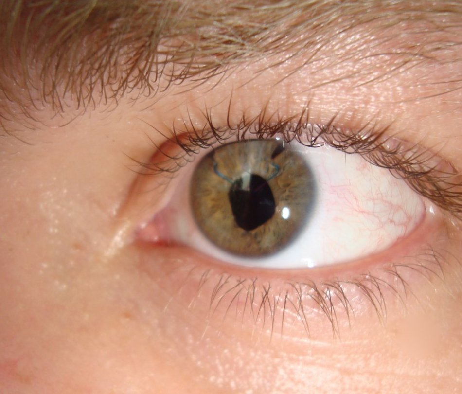 Как снимают швы после операции на глазах?