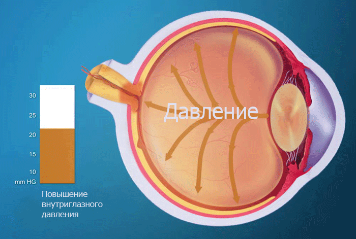 Normal pressure with eye glaucoma