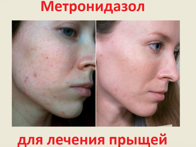 L'efficacité du métronidazole dans le traitement de l'acné sur le visage: le mécanisme d'action de l'antibiotique, aide-t-il, recettes de masques, bavardages, masques