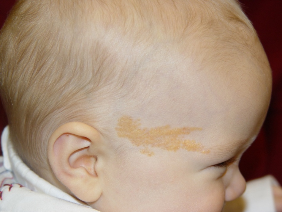 При каких заболеваниях появляются коричневые пятна у детей?