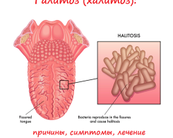 Galitosis: qué es esto: una descripción de la enfermedad, síntomas, variedades, diagnóstico, causas de apariencia, tratamiento con medicamentos, métodos populares, recetas de enjuague. ¿Qué médico trata la galitosis? Bálsamo forestal de galitosis: revisiones