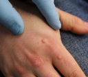 Warts appeared on the right or left hand of a woman: a sign. The wart fell off: sign