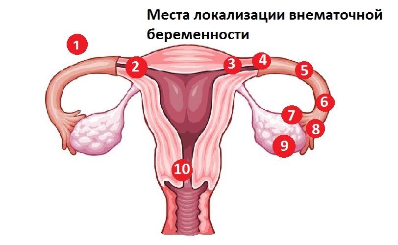 A méhen kívüli terhesség lokalizációja