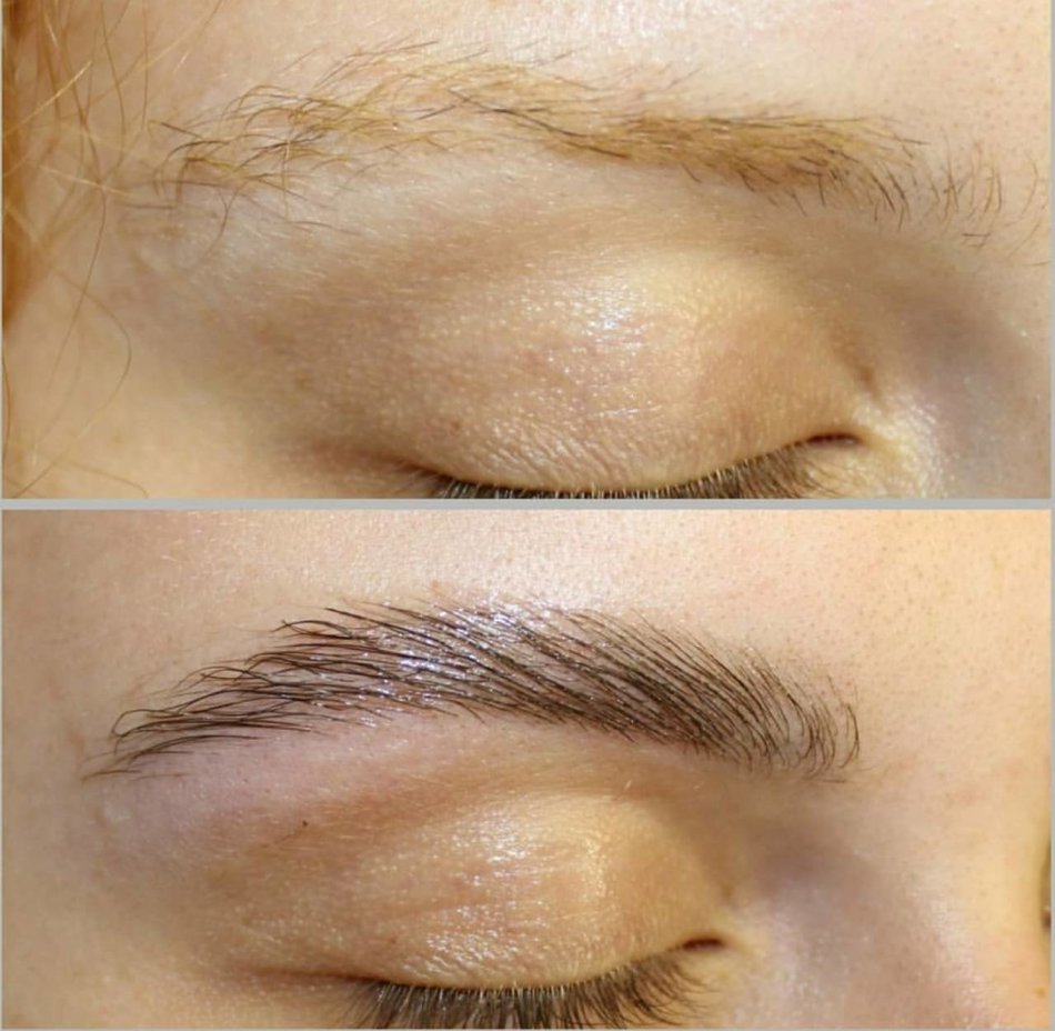 A striking example before and after the biofixation of eyebrows