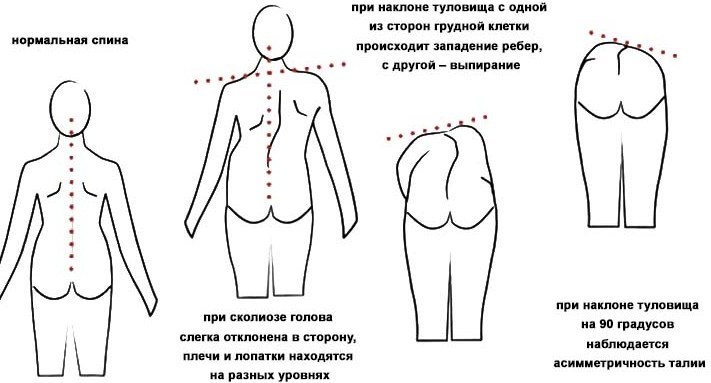 scoliosis