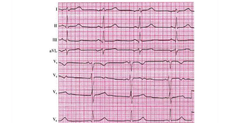 Arrhythmie