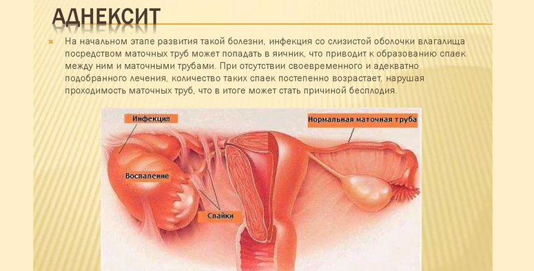 Adnexitis in gynecology