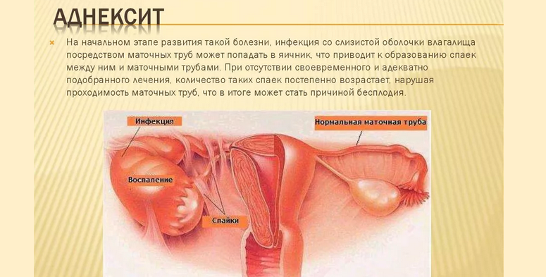 Аднексит в гинекологии