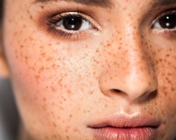 5 dokazanih načinov, kako se izogniti pigmentaciji kože: preprečevanje, domače metode, kozmetika na osnovi antioksidantov, kreme za beljenje, varčevalni olupki