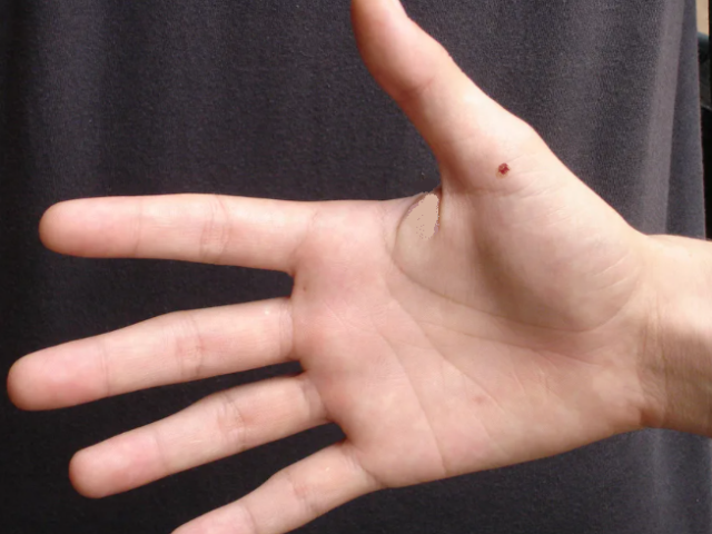 Mole sur le pouce de la main droite ou gauche - ce qui va dire: signification, signes