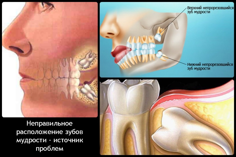 Napačna razporeditev modrostnih zob - vir številnih težav