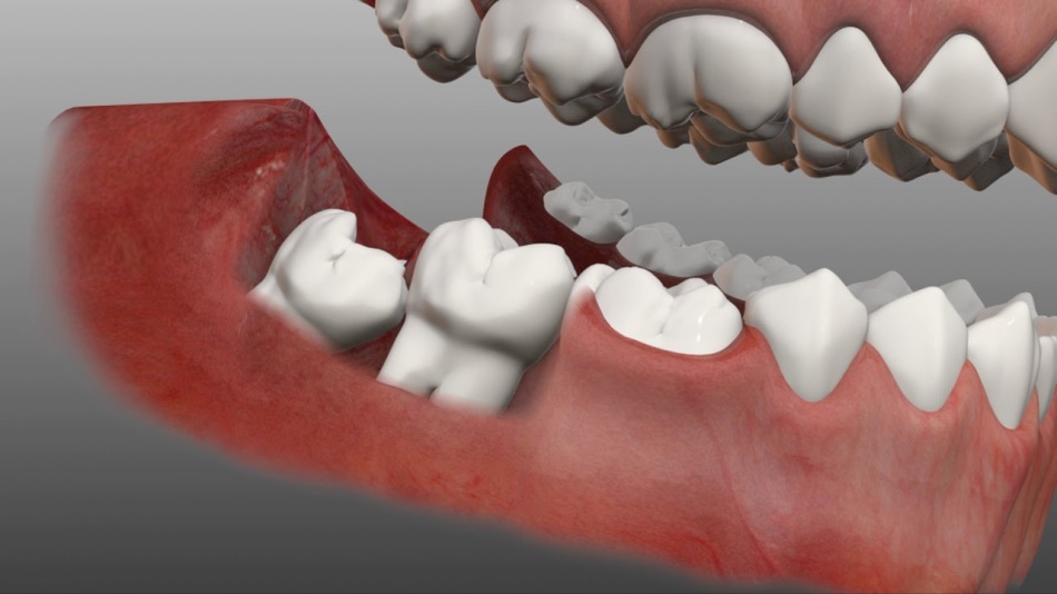 Treći molar