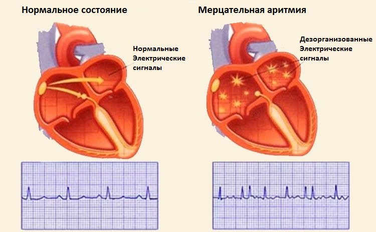 Прижигание сердца при мерцательной аритмии
