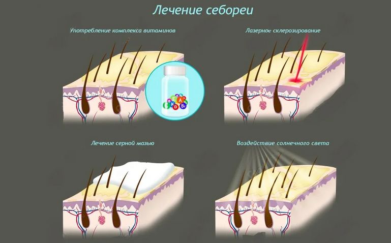 Лечение себореи